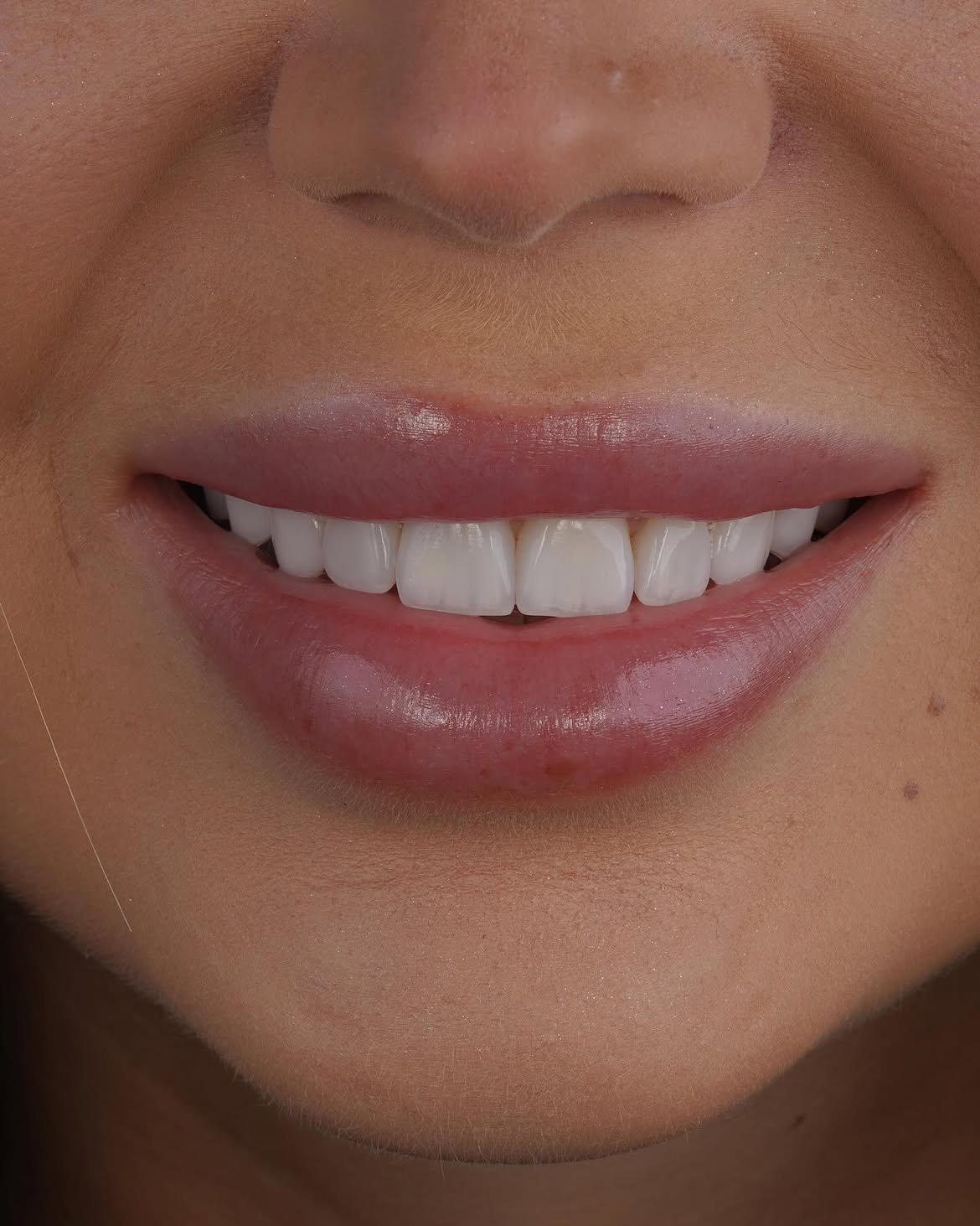 Ідеальна усмішка — робота лікарів Dentelle Clinic