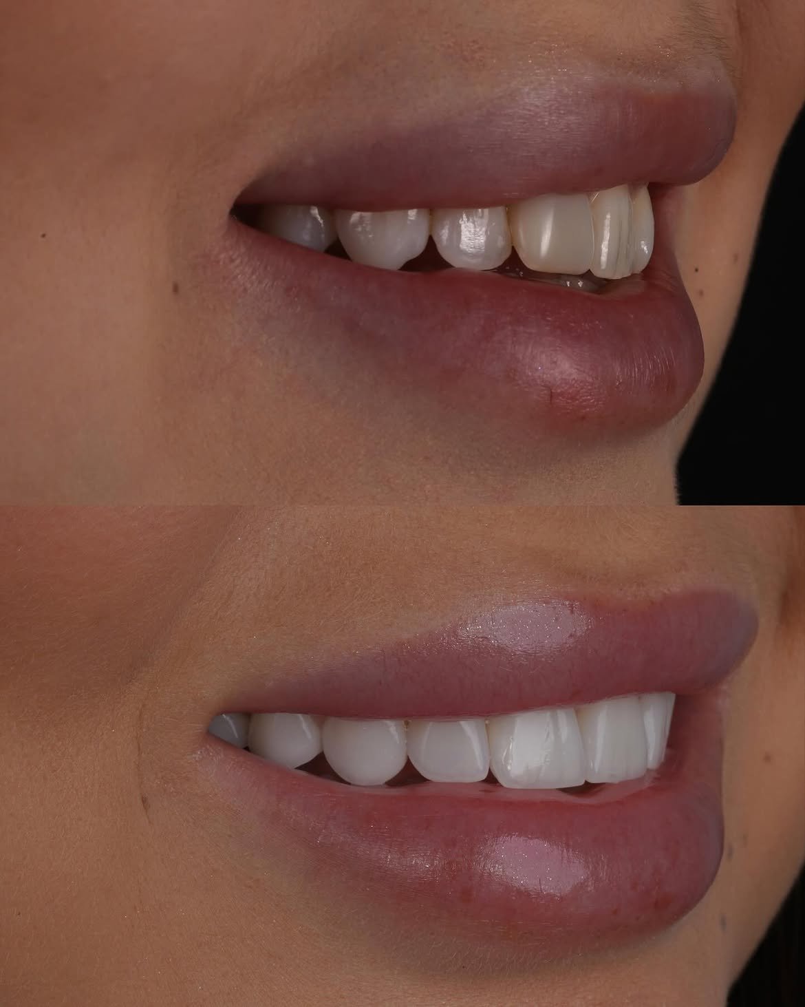 Ортопедична стоматологія та вініри Dentelle